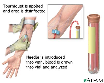 How a Blood Test is conducted